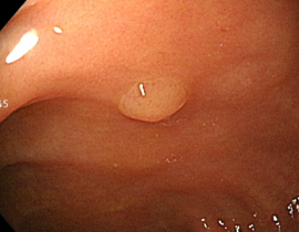 단순용종절제술 1