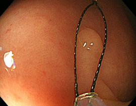 단순용종절제술 2