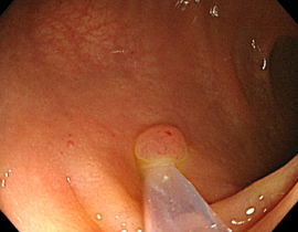 단순용종절제술 3