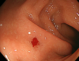 단순용종절제술 4